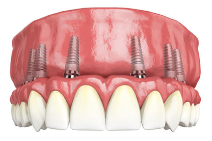 All-On-6 Implants (1 Jaw)
