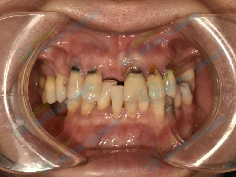 After Prosthetic