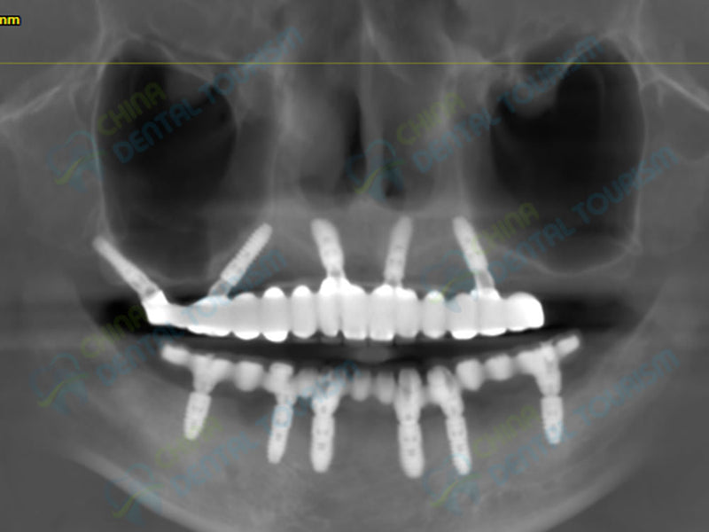 X-Ray