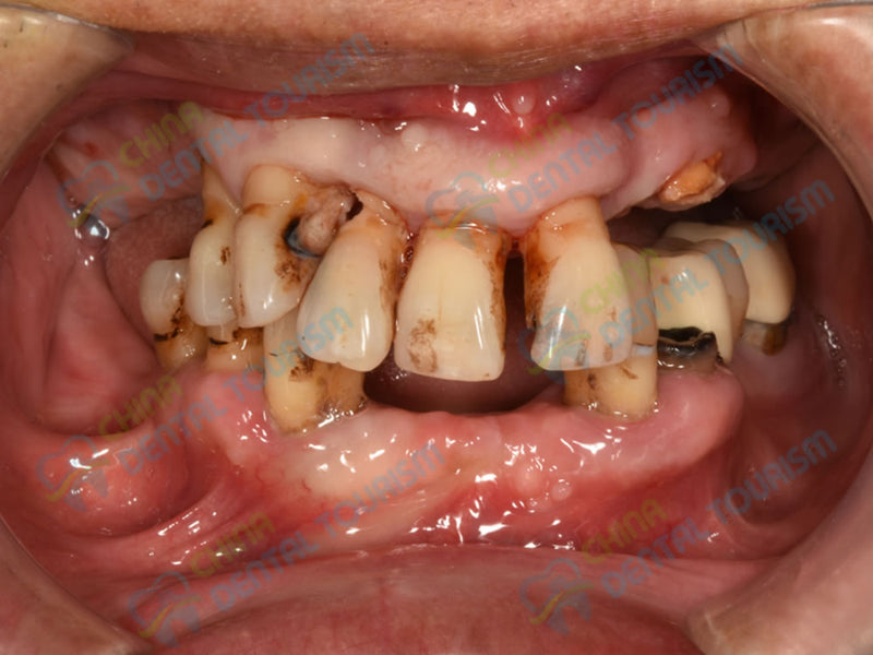 After Prosthetic