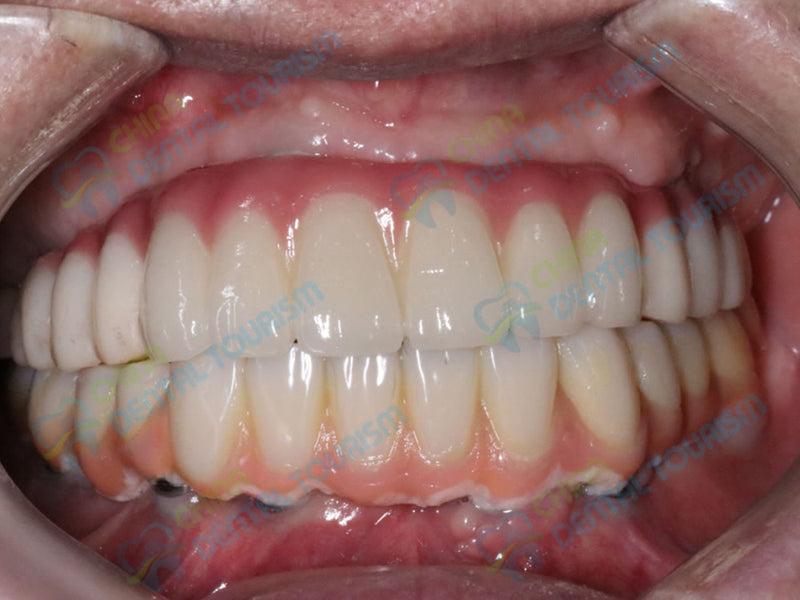 After Prosthetic