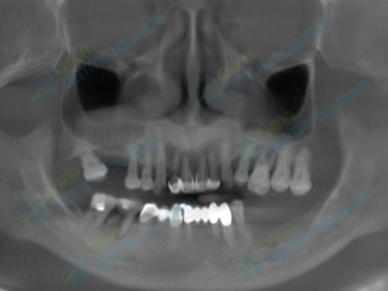 X-Ray