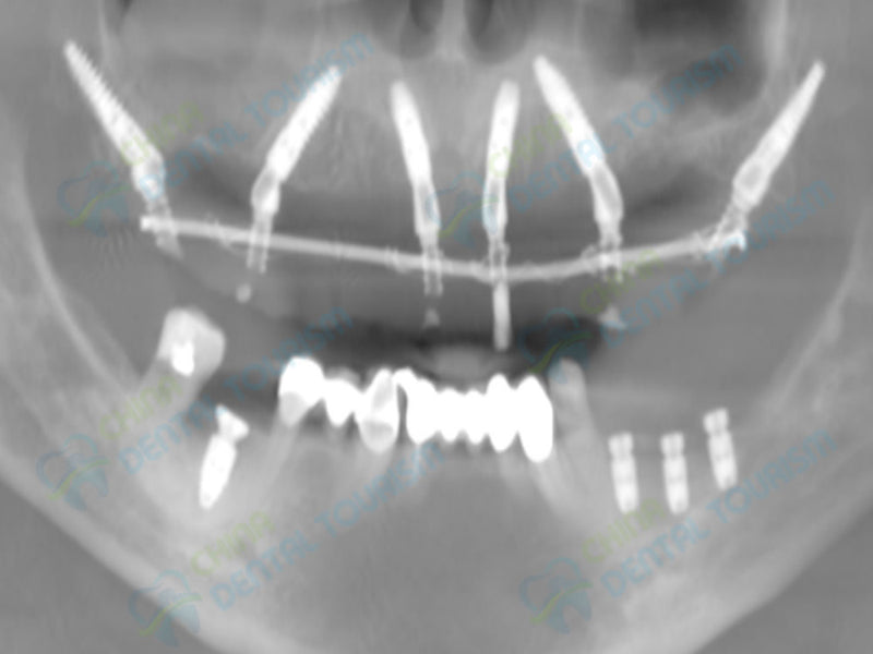 X-Ray