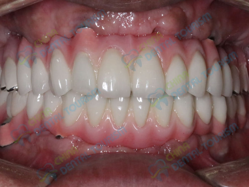 After Prosthetic