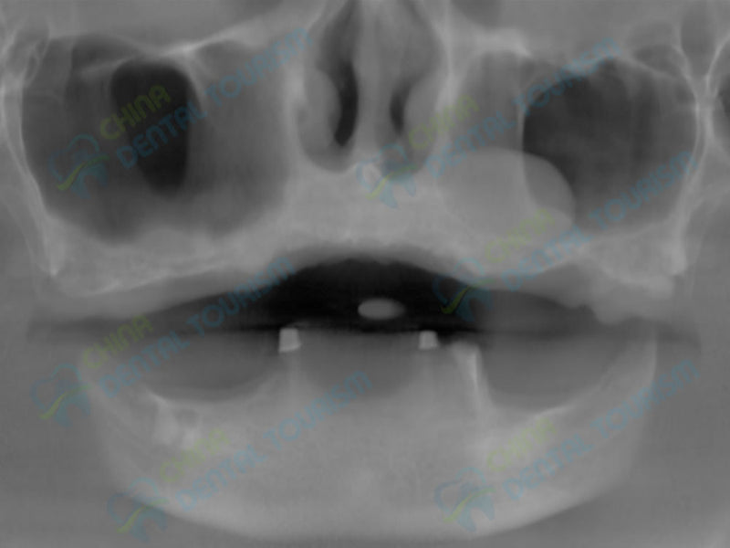 X-Ray