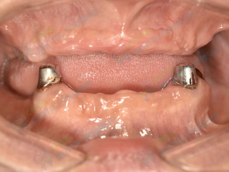 After Prosthetic