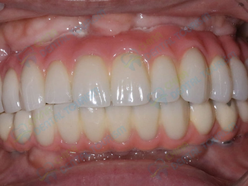 After Prosthetic