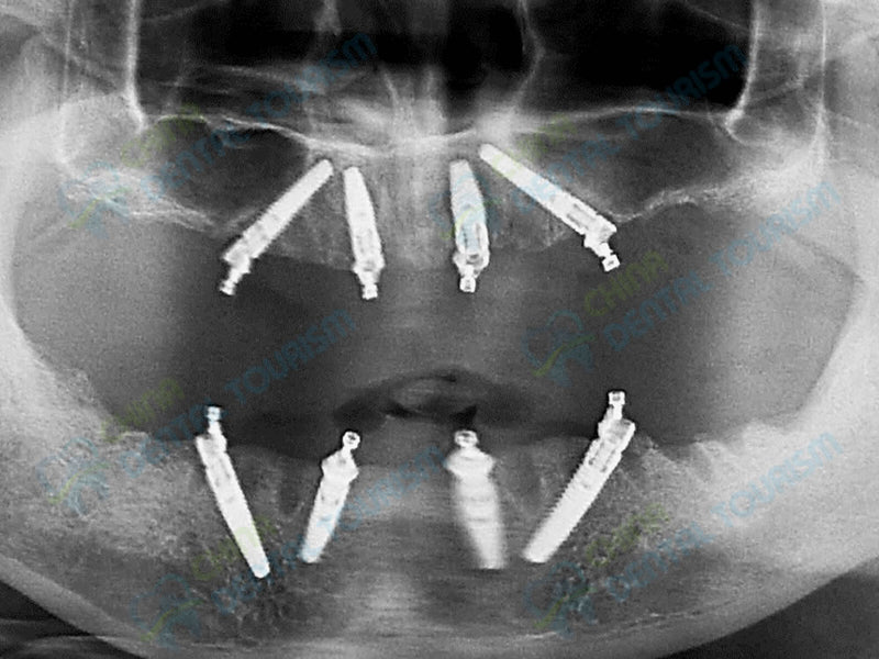 X-Ray