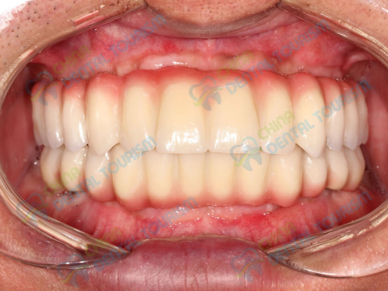 After Prosthetic