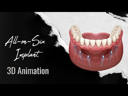 All-On-6 Implants (2 Jaws)